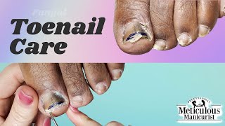 👣Lets Revisit  Toenail Fungus Care at Home👣 [upl. by Nwahsirhc667]