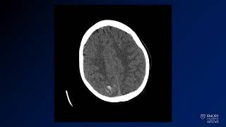 Neuroradiology board review lecture 1 case 12 [upl. by Ennairek]