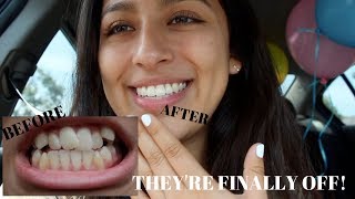 GETTING MY BRACES OFF VLOG  2017 [upl. by Waltner]