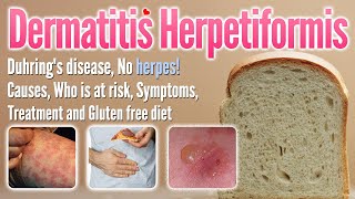 Dermatitis herpetiformis Causes Symptoms Treatment and glutenfree diet list  Duhring’s disease [upl. by Wilkie827]