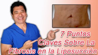 7 Puntos Claves Sobre la Fibrosis en la Liposucción [upl. by Port]