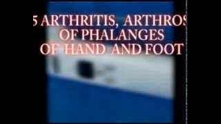 15 ARTHRITIS ARTHROSIS OF PHALANGES OF HAND AND FOOT [upl. by Nivrek]