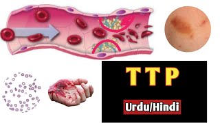 Thrombotic thrombocytopenic purpuraHemolytic uremic syndrome In urduHindiDoctors goalanimation [upl. by Sisson]