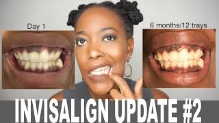 6 MONTH INVISALIGN UPDATE WITH PICTURES [upl. by Leamsi]