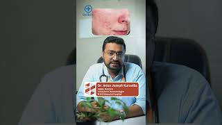 മുഖക്കുരു പാടുകൾ എങ്ങനെ എളുപ്പത്തിൽ മാറ്റാം  Acne Scars Treatment Malayalam [upl. by Willin]