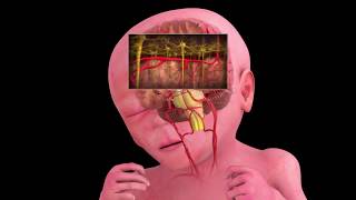 Periventricular Leukomalacia Explained by a Lawyer [upl. by Koeppel180]