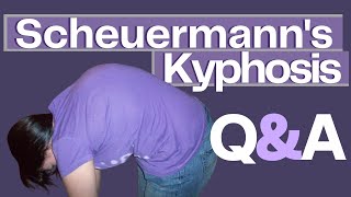 Common Questions About Scheuermanns Kyphosis [upl. by Rehtaef537]