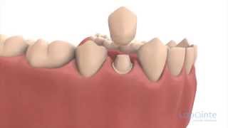 Reconstitution en prévision d’une couronne  Centres dentaires Lapointe [upl. by Ecerahc]