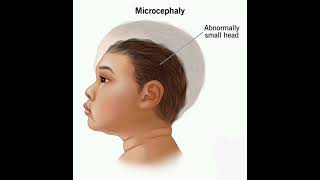 Microcephaly History mrcpch Clinical [upl. by Ferriter537]