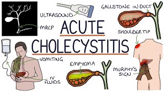 Understanding Acute Cholecystitis [upl. by Wernda]