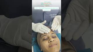 pilling treatment skincare hairlosstreatment rajkot trendingreels top reelsindia pilling [upl. by Adnawahs]