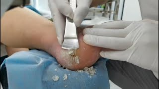 Remove Heel Fissure slowly amp carefully Cracked heel treatment amp Callus removal Dead skin removal [upl. by Powder658]