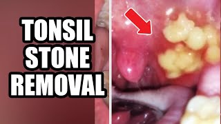 Tonsils Stone Removal Causes amp Treatment 2021 [upl. by Hoeve]