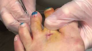 Extensor Hammertoe Surgery [upl. by Bertie]