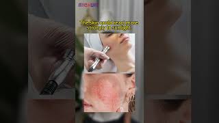 Microdermabrasion smooth results with brief side effects Worth it mychway exfoliation [upl. by Galvan]