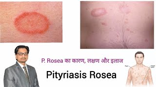 Pityriasis Rosea  P Rosea का कारण लक्षण और इलाज pityriasis rosea treatment in hindi prosea [upl. by Ortensia608]