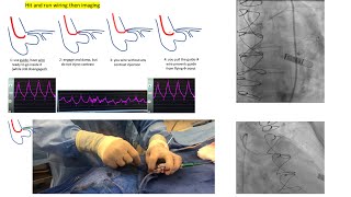 Aortoostial angiography and stenting tips and tricks  case illustrations Elias Hanna [upl. by Ynaffat107]