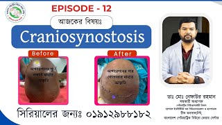 Before After Ep 12  Craniosynostosis Surgery  By Best Paediatric Neurosurgeon Nafaur in Bangladesh [upl. by Gavrilla]