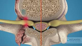 What is Cervical Lateral Stenosis AtlanticSpineCenter [upl. by Anig919]