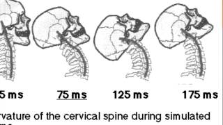 How your body gets damaged in a whiplash injury [upl. by Nosinned205]