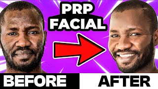 Face PRP Procedure  Benefits and Side Effects  PRP Facial Before and After  Dr Chiraag Kotecha [upl. by Terti830]