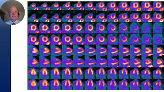 Common Artifacts with Cardiac PETCT Myocardial Perfusion Imaging Misregistration [upl. by Orpha]