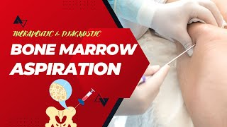 Bone Marrow Aspiration Exploring a Diagnostic and Therapeutic Procedure bonemarrowaspiration [upl. by Enneicul]