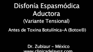 Disfonía Espasmódica Variante Tensional pre y post Botox® [upl. by Rbma]