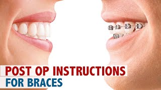 Post Op Instructions For Braces [upl. by Herc]