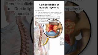 Complications of multiple myeloma [upl. by Charlet]