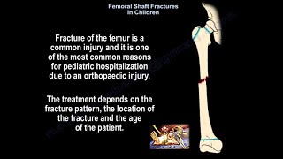 Femoral Shaft Fracture in Children  Everything You Need To Know  Dr Nabil Ebraheim [upl. by Aikas]