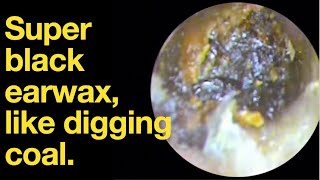 Super black earwax like digging coal ear wax removal  ear cleaning  ASMR  relaxation  relax [upl. by Anavrin]