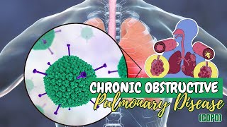 New Advances in Treatment and Understanding of Chronic Obstructive Pulmonary Disease [upl. by Royall664]