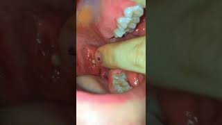 tonsil stone removal 1 warning cautionshorts [upl. by Lehcem]