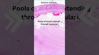 Histology of colitis cystica profunda [upl. by Mobley743]