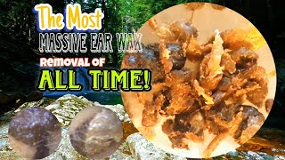 The Most Massive Ear Wax Removal of All Time [upl. by Ellemac817]