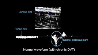 Venous ultrasound course Deciphering DVT waveforms [upl. by Gwenore]