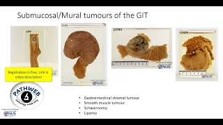 Colon Large intestine Leiomyoma Gross pathology [upl. by Sargent]