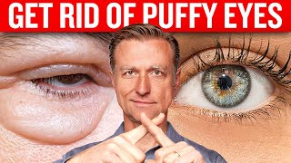 Get Rid of Puffy Eyes for Good with Dr Bergs Proven Techniques [upl. by Natelson]