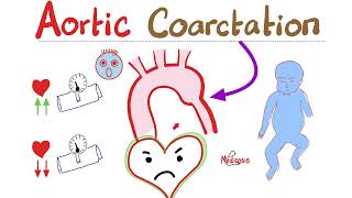 Coarctation of the Aorta  Cardiology Series  Types Symptoms Signs Diagnosis amp Treatment [upl. by Nirb436]