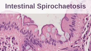 Intestinal Spirochaetosis  Pathology mini tutorial [upl. by Ainimreh]