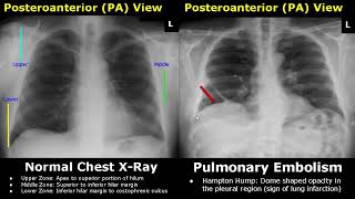 Chest XRay Lung Normal Vs Abnormal Image Appearances Part 2  Pleural EffusionPneumothorax PA CXR [upl. by Aynotahs]