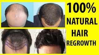 How To Regrow Hair Naturally For Men  100 Natural [upl. by La]