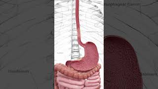 🔬 Understanding Esophageal Cancer Early Detection Is Key 🔬 anatomy [upl. by Yennek]