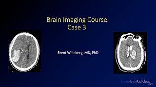 Brain imaging course – Unknown case 3 [upl. by Remsen]