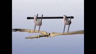 Distal Radius External Fixator for multifragmentary fractures [upl. by Javier]