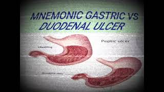 MNEMONIC GASTRIC ULCER VS DUODENAL ULCERmedicinelectures medicineeducationtalks medilectures [upl. by Renba]