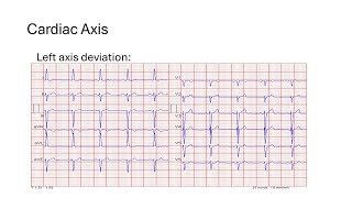 Cardiac Axis [upl. by Alice453]