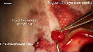 Implanted conjunctival cystyoung boyintoto excision [upl. by Nesahc]