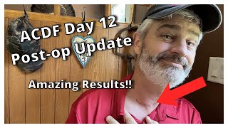 ACDF Miracle Recovery Day 12 Tips and What To Expect [upl. by Sul]